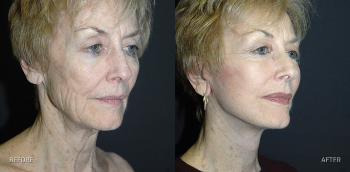 - facelifts-facialneckplasty-the-pinch-patient-10-b